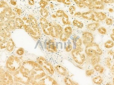 BMP8B Antibody - DF8507 at 1/100 staining human renal cell carcinoma by IHC-P.
