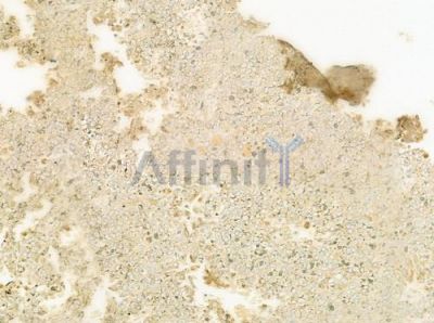 Cardiotrophin-1 Antibody - DF8513 at 1/100 staining human melanoma by IHC-P.