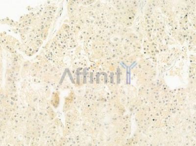 FucT-IV Antibody - DF8547 at 1/100 staining human hepatocellular carcinoma by IHC-P.