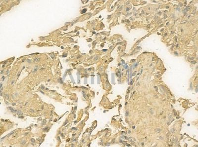 IgA Antibody - DF8563 at 1/100 staining human lung squamous cell carcinoma by IHC-P.