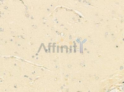 MaxiK beta Antibody - DF8571 at 1/100 staining human glioblastoma by IHC-P.