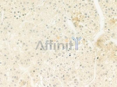 Na+ CP type II alpha Antibody - DF8575 at 1/100 staining human hepatocellular carcinoma by IHC-P.