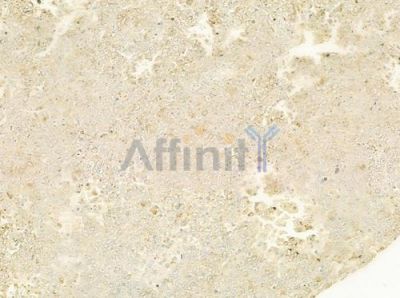Netrin-1 Antibody - DF8579 at 1/100 staining human melanoma by IHC-P.