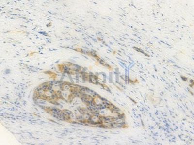 Podocin Antibody - DF8593 at 1/100 staining human esophageal carcinoma by IHC-P.