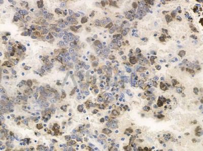 SMYD2 Antibody - DF8613 at 1/100 staining human melanoma by IHC-P.
