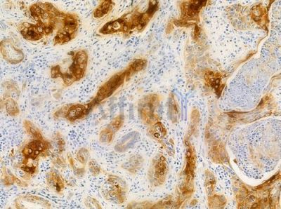 ACTN1/2/3/4 Antibody - DF8633 at 1/100 staining human esophageal carcinoma by IHC-P.