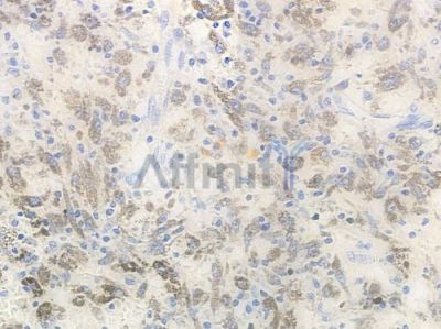 ADCK4 Antibody - DF8634 at 1/100 staining human melanoma by IHC-P.