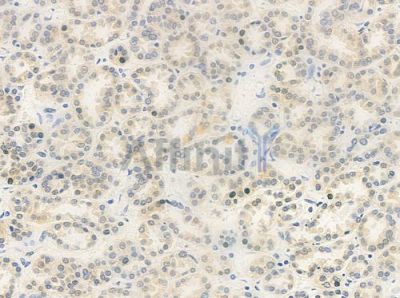 CD2 Tail-binding Antibody - DF8644 at 1/100 staining human renal cell carcinoma by IHC-P.