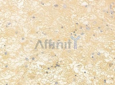 PER3 Antibody - DF8706 at 1/100 staining human astrocytoma by IHC-P.