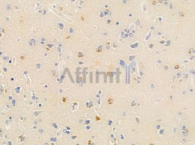 ZNF23 Antibody - DF8734 at 1/100 staining human glioblastoma by IHC-P.