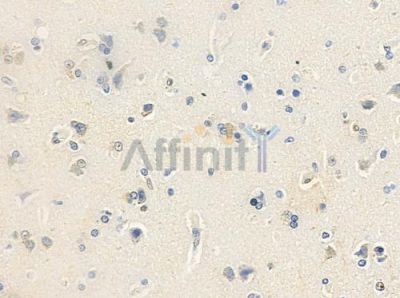 ANP32D Antibody - DF8770 at 1/100 staining human glioblastoma by IHC-P.