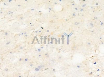 SFRS6 Antibody - DF8824 at 1/100 staining human astrocytoma by IHC-P.