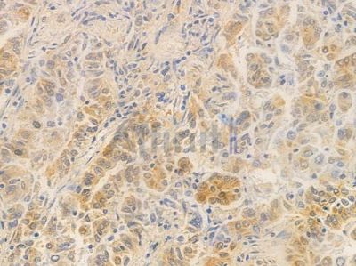 MTF1 Antibody - DF8827 at 1/100 staining human lung adenocarcinoma by IHC-P.
