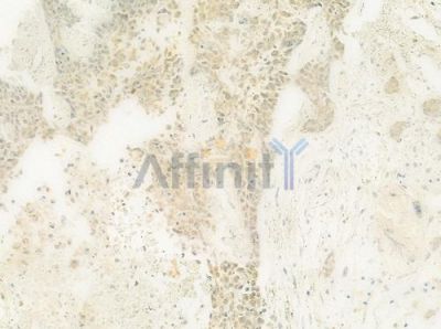 SART3 Antibody - DF8829 at 1/100 staining human breast carcinoma by IHC-P.