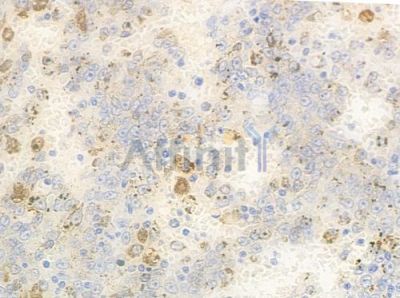 AGK Antibody - DF8835 at 1/100 staining human melanoma by IHC-P.