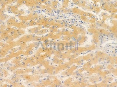 TENS3 Antibody - DF8838 at 1/100 staining human hepatocellular carcinoma by IHC-P.