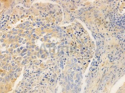 TENS3 Antibody - DF8838 at 1/100 staining human lung squamous cell carcinoma by IHC-P.