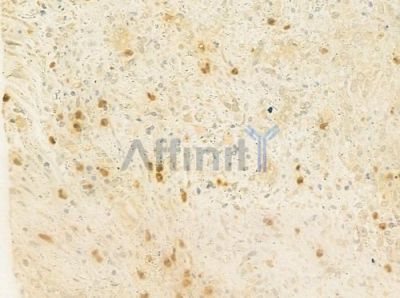 FOG2 Antibody - DF8852 at 1/100 staining human prostate carcinoma by IHC-P.
