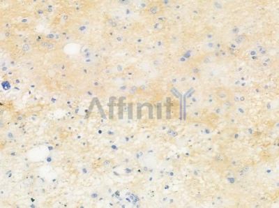 PSKH2 Antibody - DF8863 at 1/100 staining human astrocytoma by IHC-P.