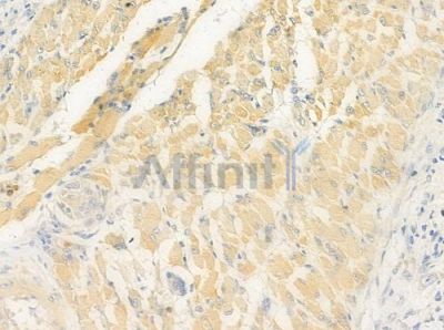PCDH-X/Y Antibody - DF8867 at 1/100 staining human tongue carcinoma by IHC-P.