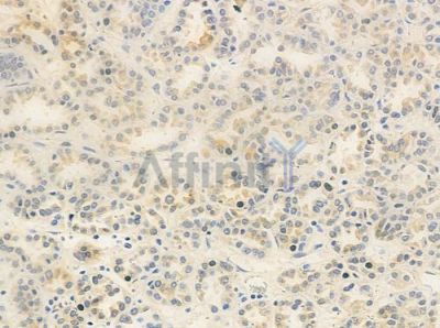 MBIP1 Antibody - DF8877 at 1/100 staining human renal cell carcinoma by IHC-P.