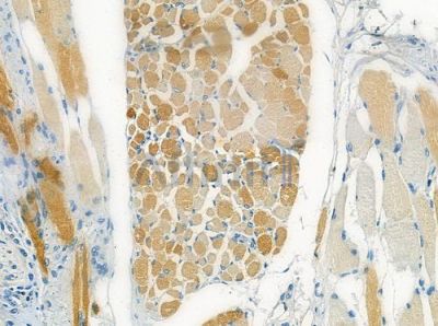 KCIP1 Antibody - DF8880 at 1/100 staining human tongue carcinoma by IHC-P.