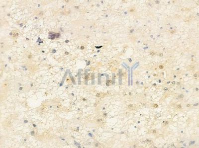 MKL2 Antibody - DF8885 at 1/100 staining human astrocytoma by IHC-P.