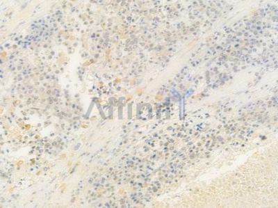 MAFB Antibody - DF8895 at 1/100 staining human prostate carcinoma by IHC-P.