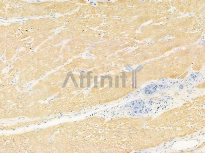 Cytochrome P450 2F1 Antibody - DF8909 at 1/100 staining human gastric carcinoma by IHC-P.