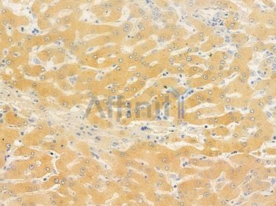 Cytochrome P450 2F1 Antibody - DF8909 at 1/100 staining human hepatocellular carcinoma by IHC-P.