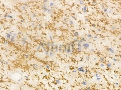 HSP76 Antibody - DF8956 at 1/100 staining human astrocytoma by IHC-P.