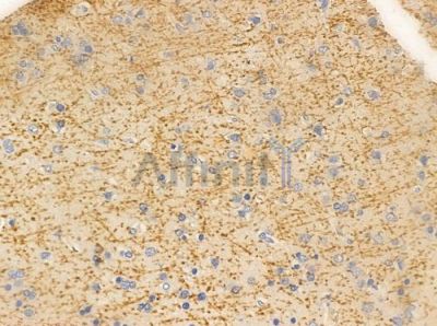HSP76 Antibody - DF8956 at 1/100 staining human glioblastoma by IHC-P.