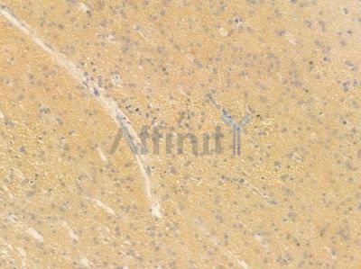 IFNA7 Antibody - DF8972 at 1/100 staining human glioblastoma by IHC-P.