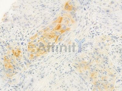 IRGC Antibody - DF8978 at 1/100 staining human tongue carcinoma by IHC-P.