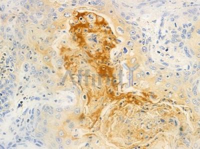 K1H5 Antibody - DF9005 at 1/100 staining human esophageal carcinoma by IHC-P.