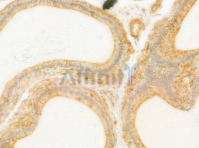 MAGB4 Antibody - DF9017 at 1/100 staining human testicular cancer by IHC-P.