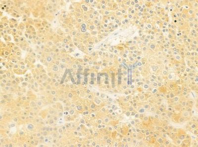 CYB5R4 Antibody - DF9025 at 1/100 staining human hepatocellular carcinoma by IHC-P.