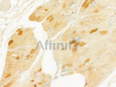 MRPS18B Antibody - DF9096 at 1/100 staining human tongue carcinoma by IHC-P.