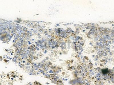 MRPL37 Antibody - DF9108 at 1/100 staining human melanoma by IHC-P.