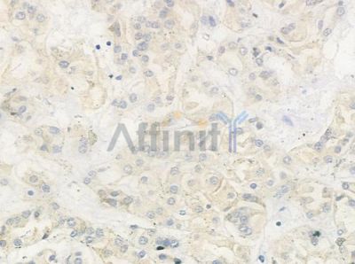MRPL37 Antibody - DF9108 at 1/100 staining human renal cell carcinoma by IHC-P.