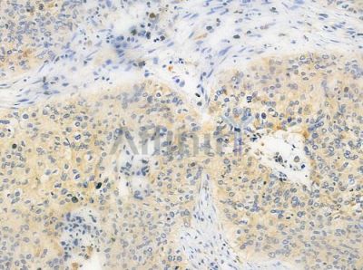 RPS21 Antibody - DF9119 at 1/100 staining human lung squamous cell carcinoma by IHC-P.