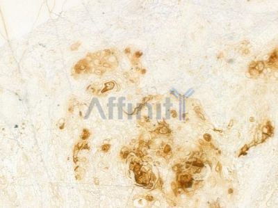 ADAMTS17 Antibody - DF9174 at 1/100 staining human esophageal carcinoma by IHC-P.