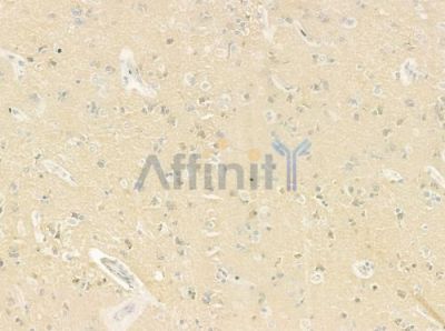 ALMS1 Antibody - DF9197 at 1/100 staining human glioblastoma by IHC-P.