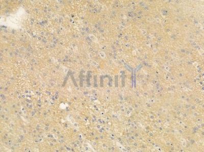 AAMP Antibody - DF9207 at 1/100 staining human glioblastoma by IHC-P.