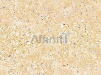 AAMP Antibody - DF9207 at 1/100 staining human astrocytoma by IHC-P.