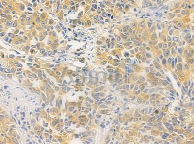 RECQL4 Antibody - DF9257 at 1/100 staining human lung squamous cell carcinoma by IHC-P.