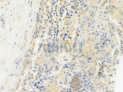 RECQL4 Antibody - DF9257 at 1/100 staining human lung squamous cell carcinoma by IHC-P.