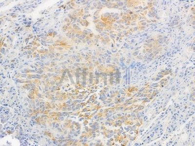 BAGE5 Antibody - DF9265 at 1/100 staining human lung squamous cell carcinoma by IHC-P.