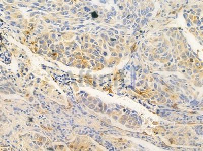 SLC25A14 Antibody - DF9283 at 1/100 staining human lung squamous cell carcinoma by IHC-P.