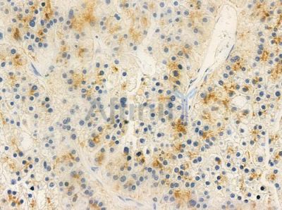 PDE1B Antibody - DF9299 at 1/100 staining human hepatocellular carcinoma by IHC-P.